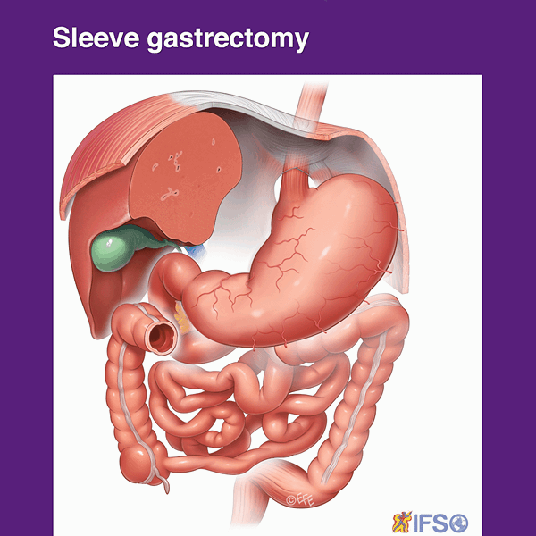 Sleeve Gastrectomy. (Продольная резекция желудка).