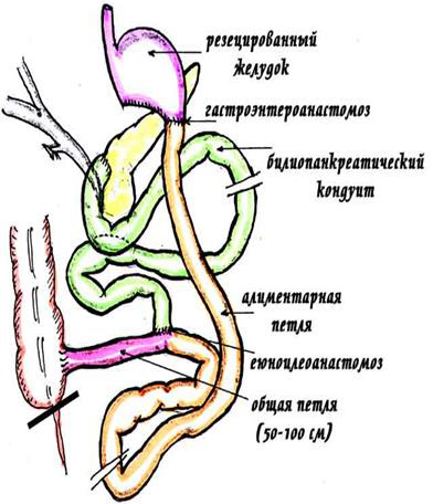 Схема билиопанкреотического шунтирования